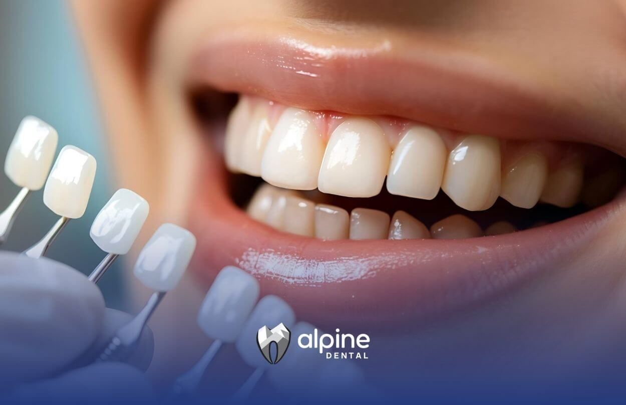 Are Veneers Reversible or Permanent?