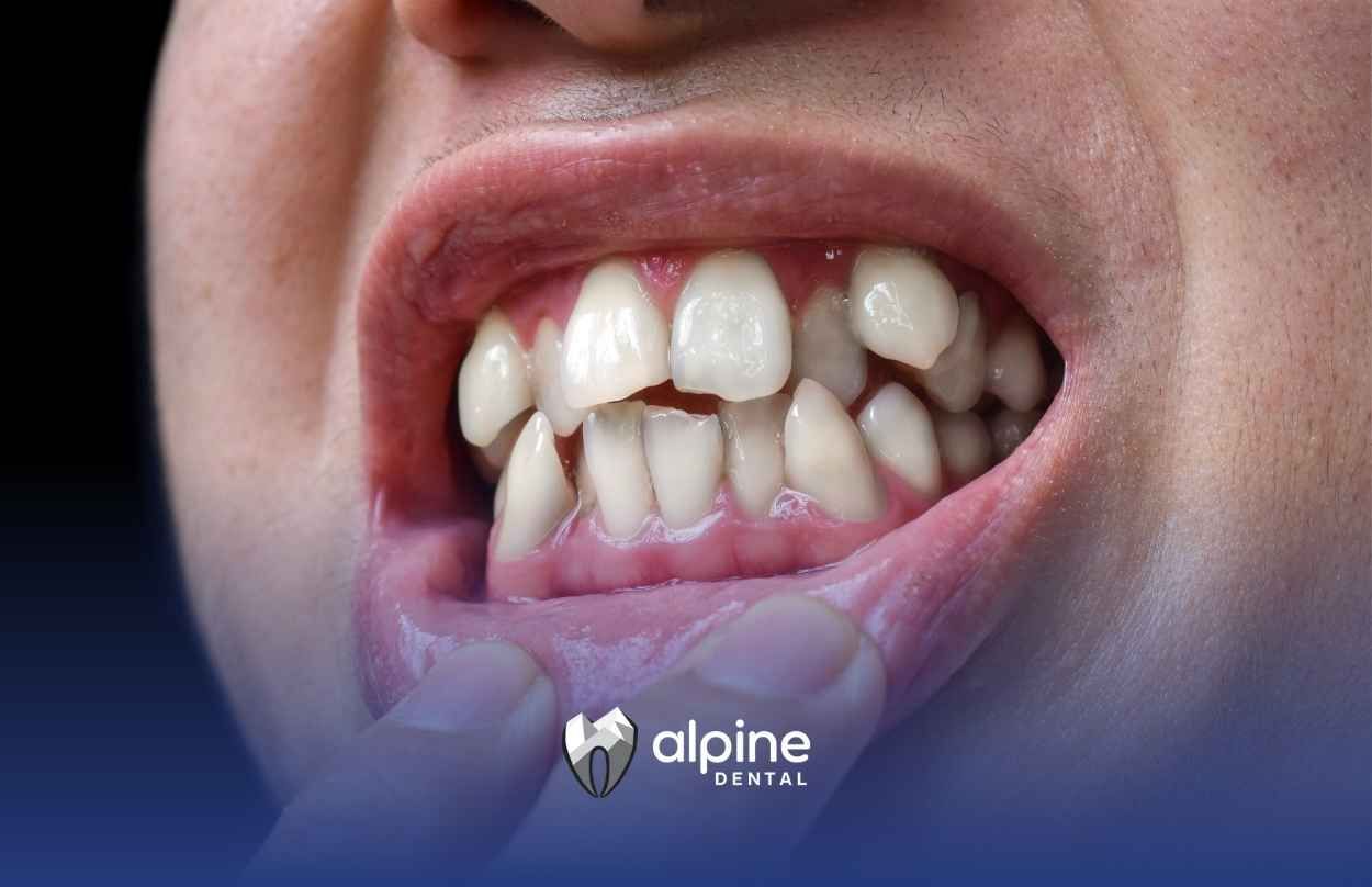 Can Misaligned Teeth Be Fixed? Real Solutions Explained