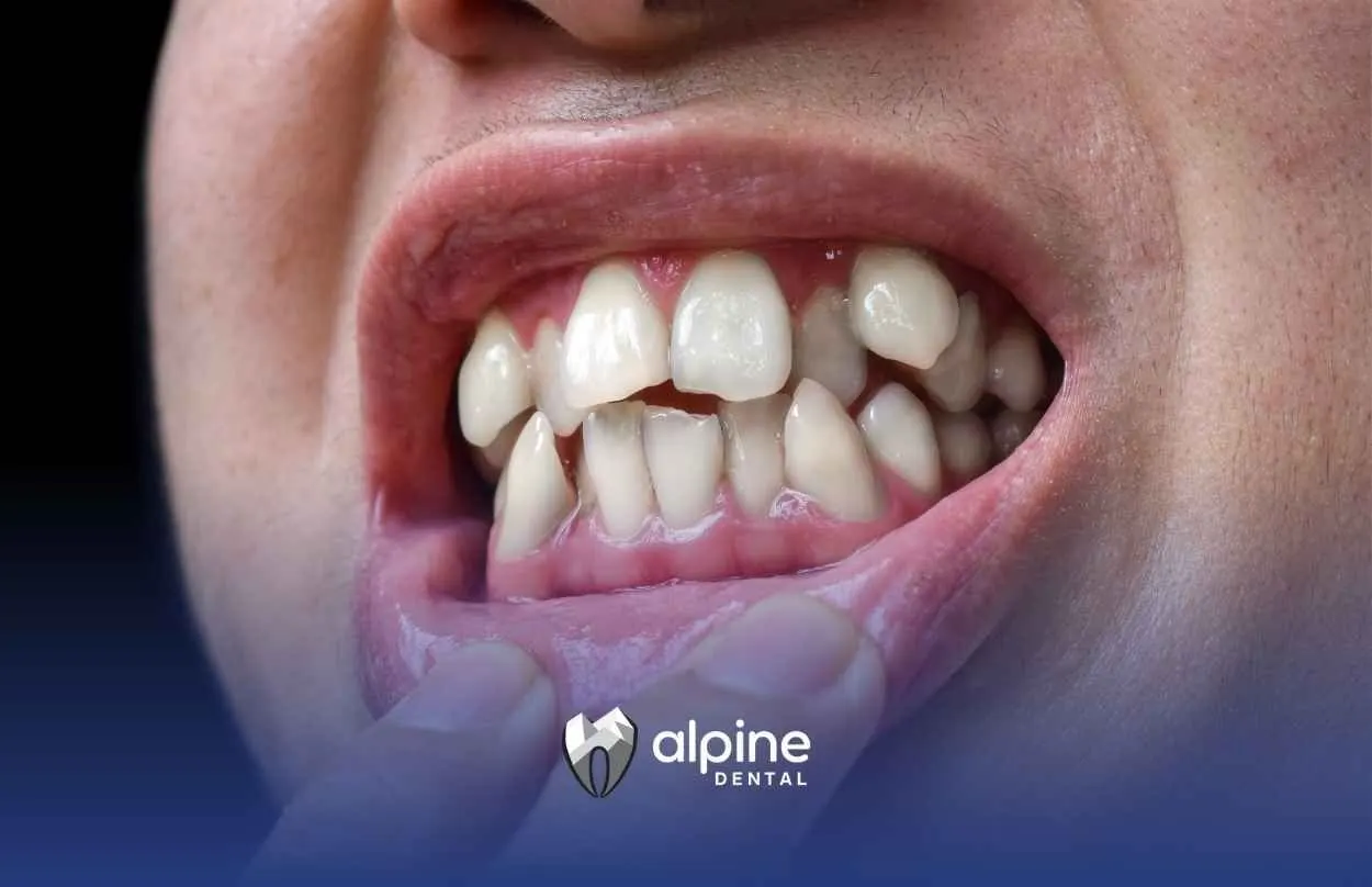 Can Misaligned Teeth Be Fixed? Real Solutions Explained