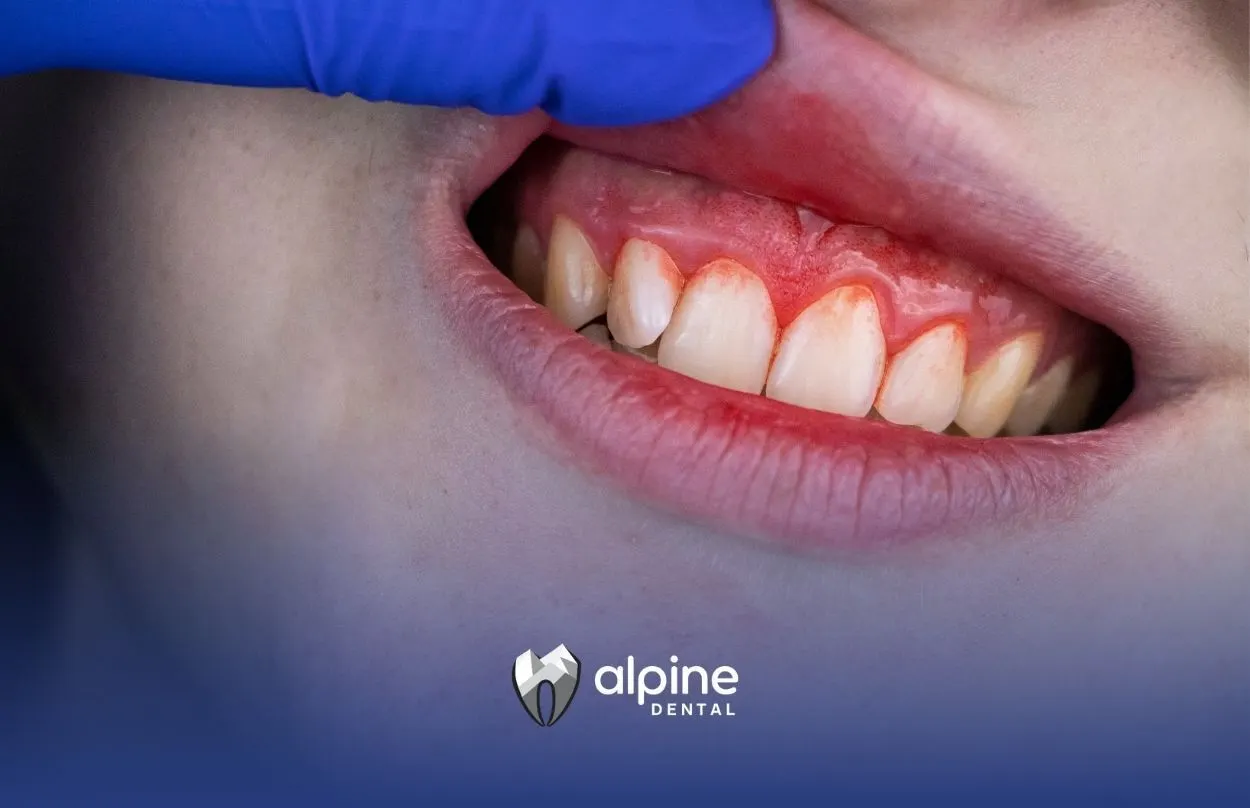 What Is Periodontal Disease? Understanding Gum Health and Treatment Options