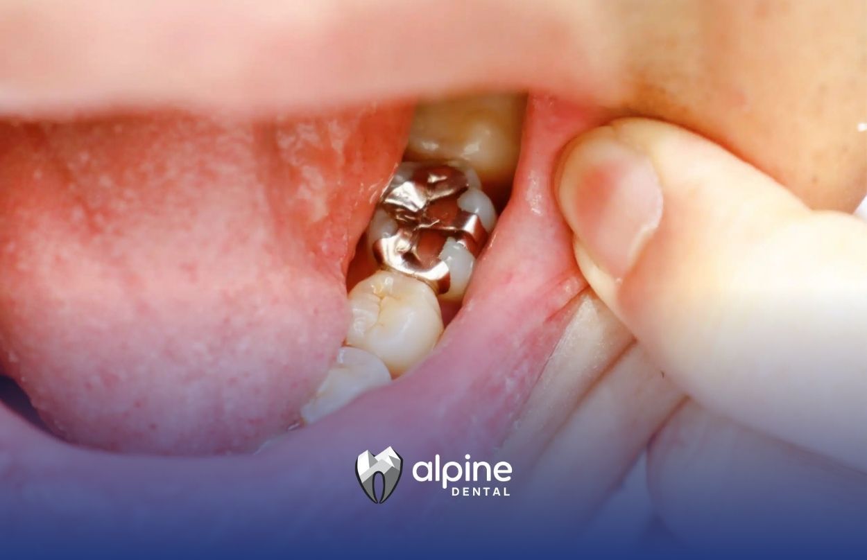 Dental Fillings: A Lifesaver for Kids and Seniors Alike