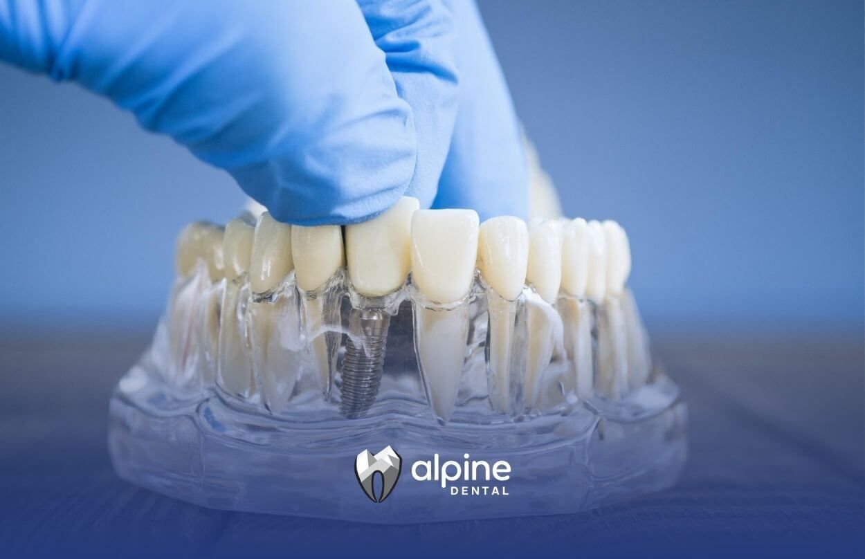 Dental Implant vs Bridge: Costs, Benefits & Longevity
