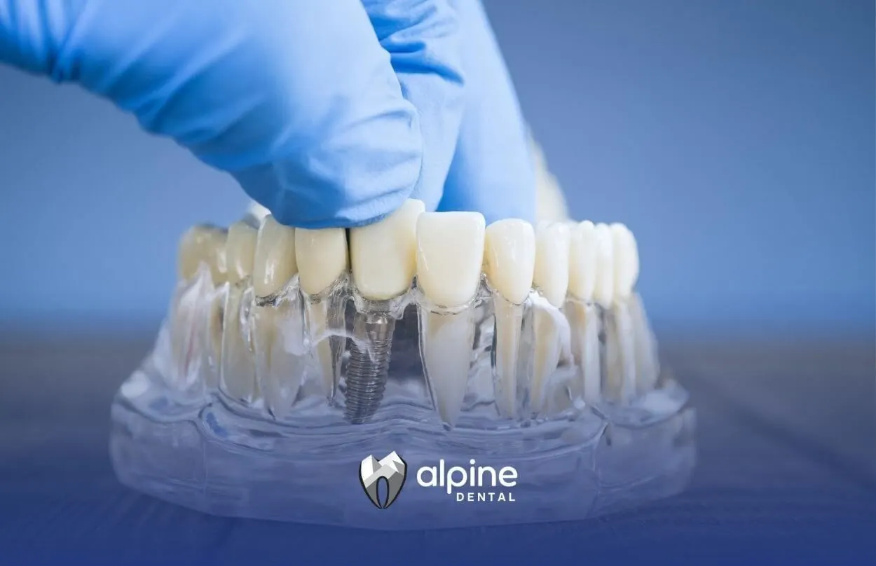 Dental Implant vs Bridge: Costs, Benefits & Longevity