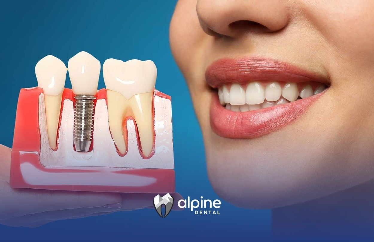 Exploring Dental Implants: Essential Information for Families