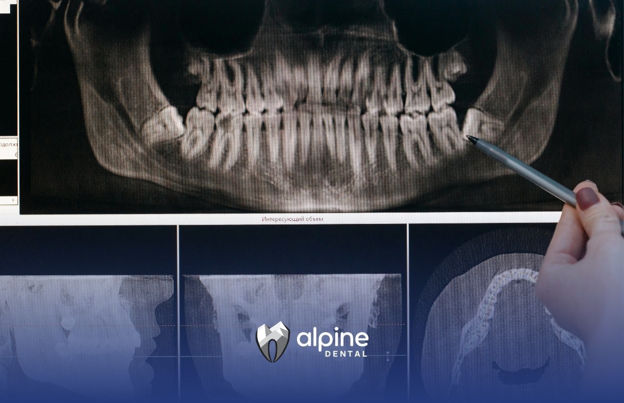 Why Do We Have Wisdom Teeth? The Evolution, Purpose, and Modern-Day Facts