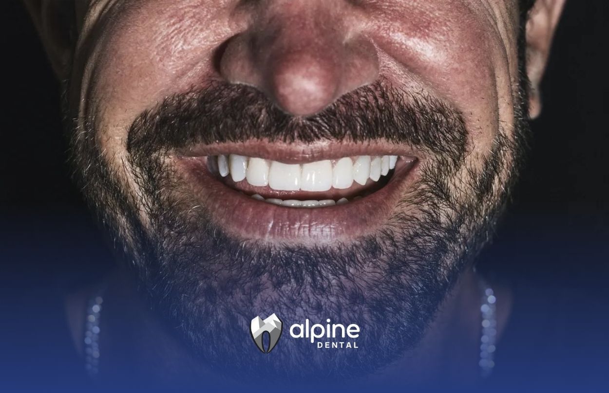 Do All Celebrities Have Veneers?