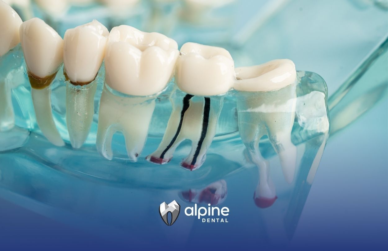 Symptoms of Jaw Infection After Root Canal: What to Watch For and When to Act