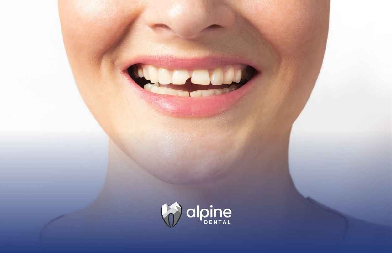 Is It OK to Leave a Broken Tooth? The Facts You Need