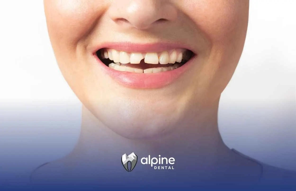 Is It OK to Leave a Broken Tooth? The Facts You Need