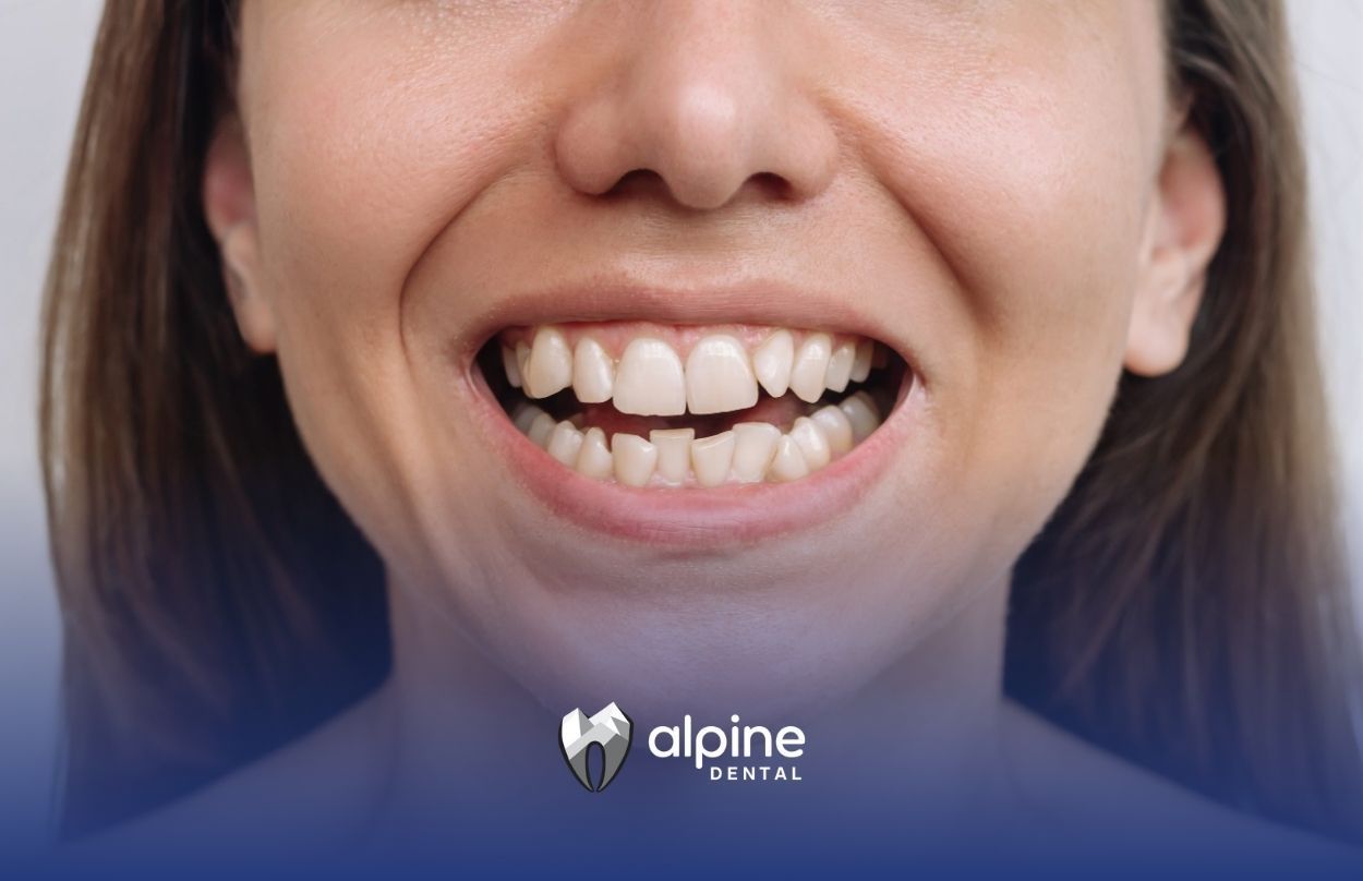 Is It Possible to Restore Bad Teeth?