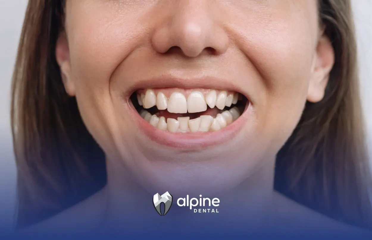 Is It Possible to Restore Bad Teeth?