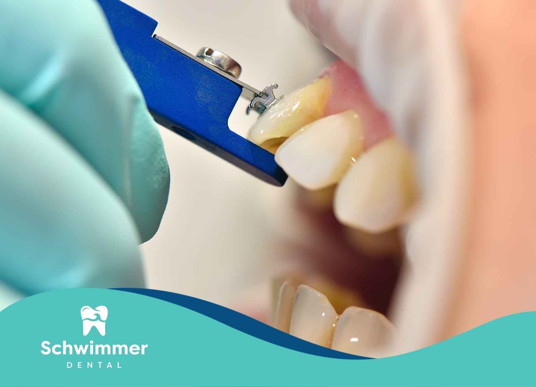 Who Shouldn't Get Veneers? Key Contraindications Explained