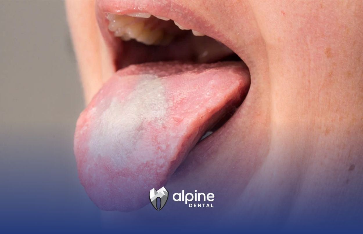 Key Oral Yeast Infection Symptoms That Indicate a Problem
