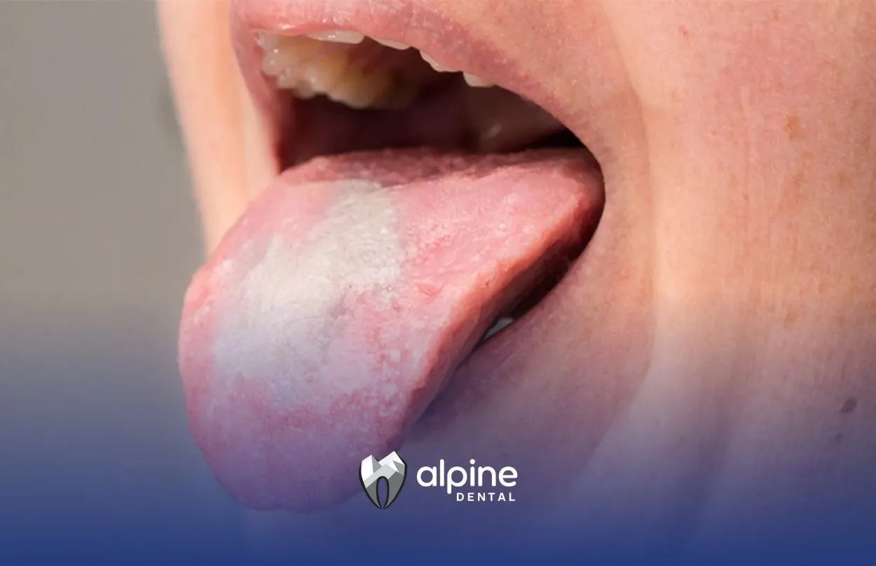 Key Oral Yeast Infection Symptoms That Indicate a Problem
