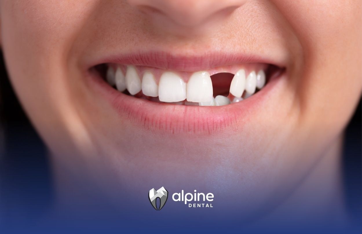From Single Tooth to Full Mouth: Exploring Your Teeth Replacement Options