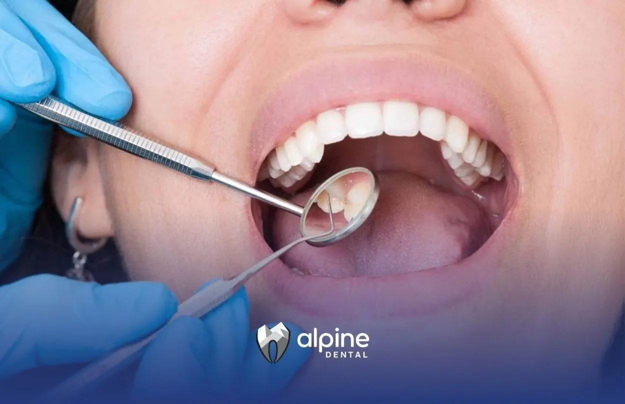 Essential Tips for Tooth Decay Treatment