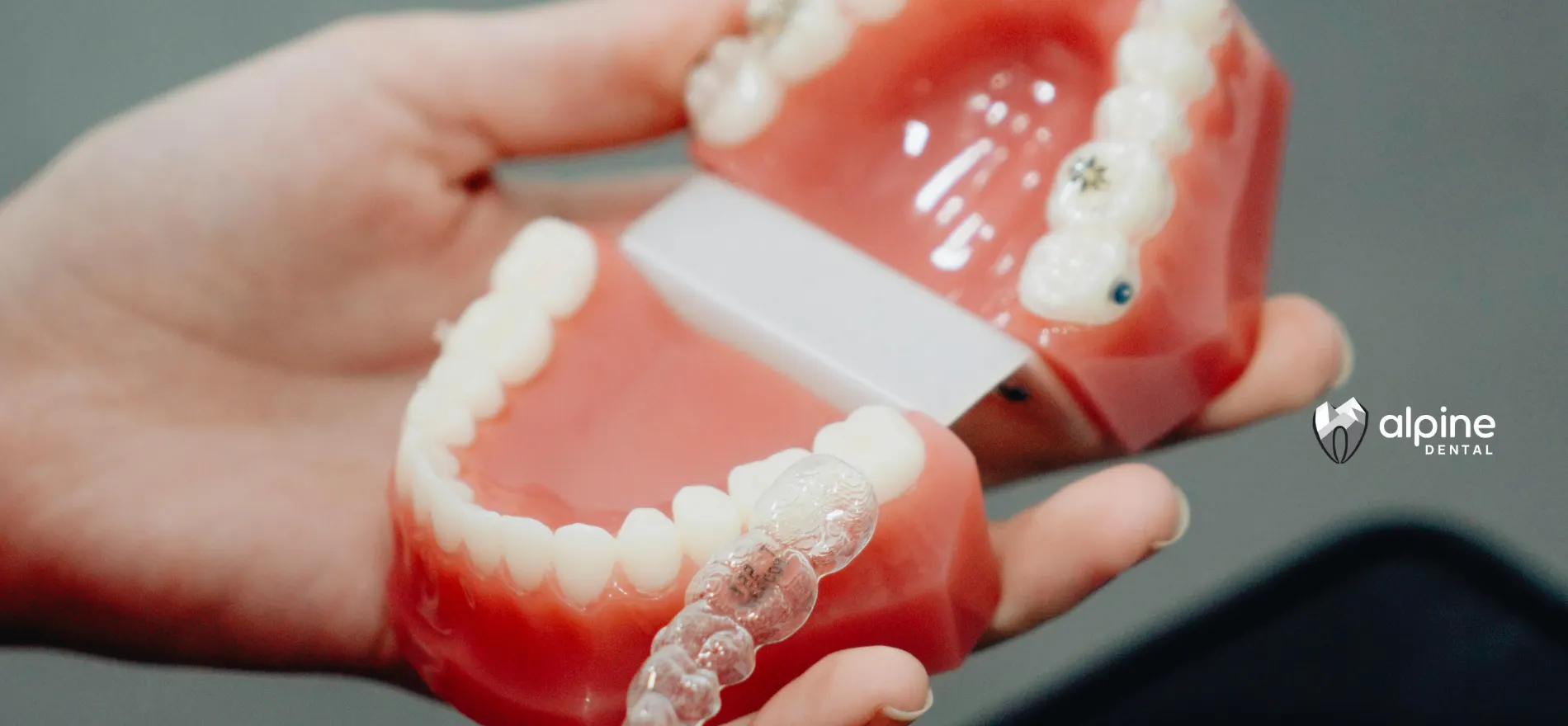 Types of Retainers: Which One Is Right for You?