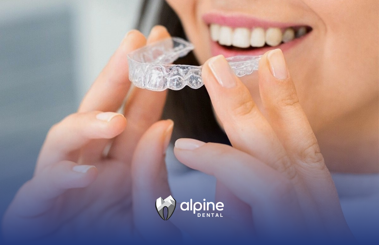 What Are Emax Veneers? Review of Features and Cost