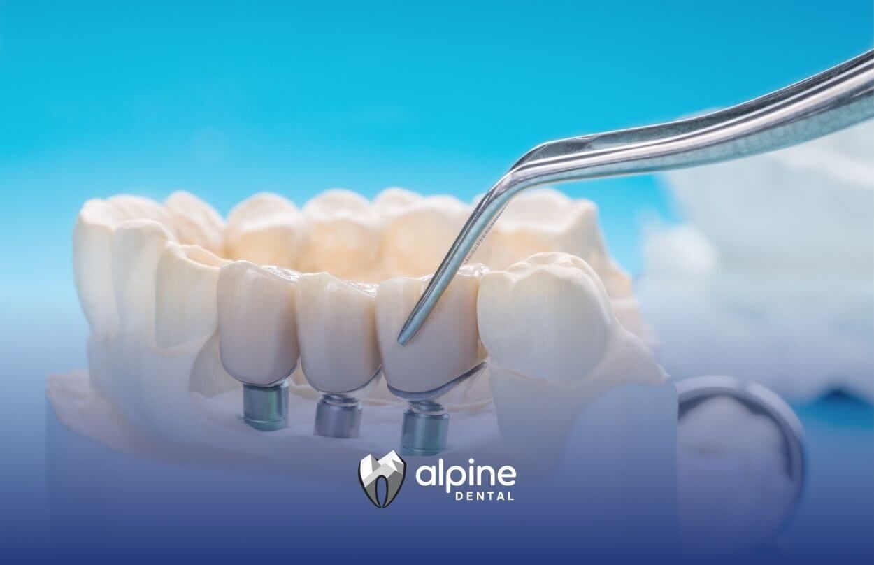 Endosteal Implants: Why They're the #1 Choice for Tooth Replacement