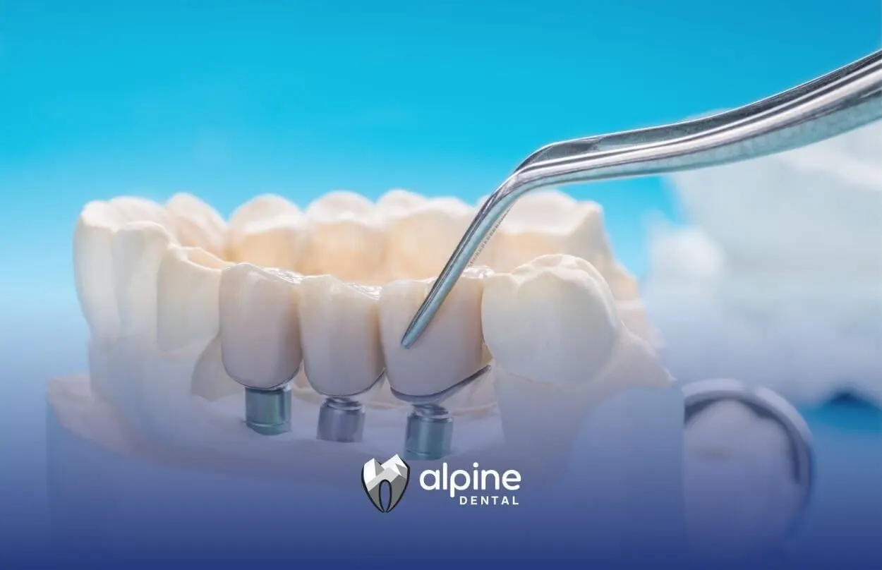 Endosteal Implants: Why They're the #1 Choice for Tooth Replacement