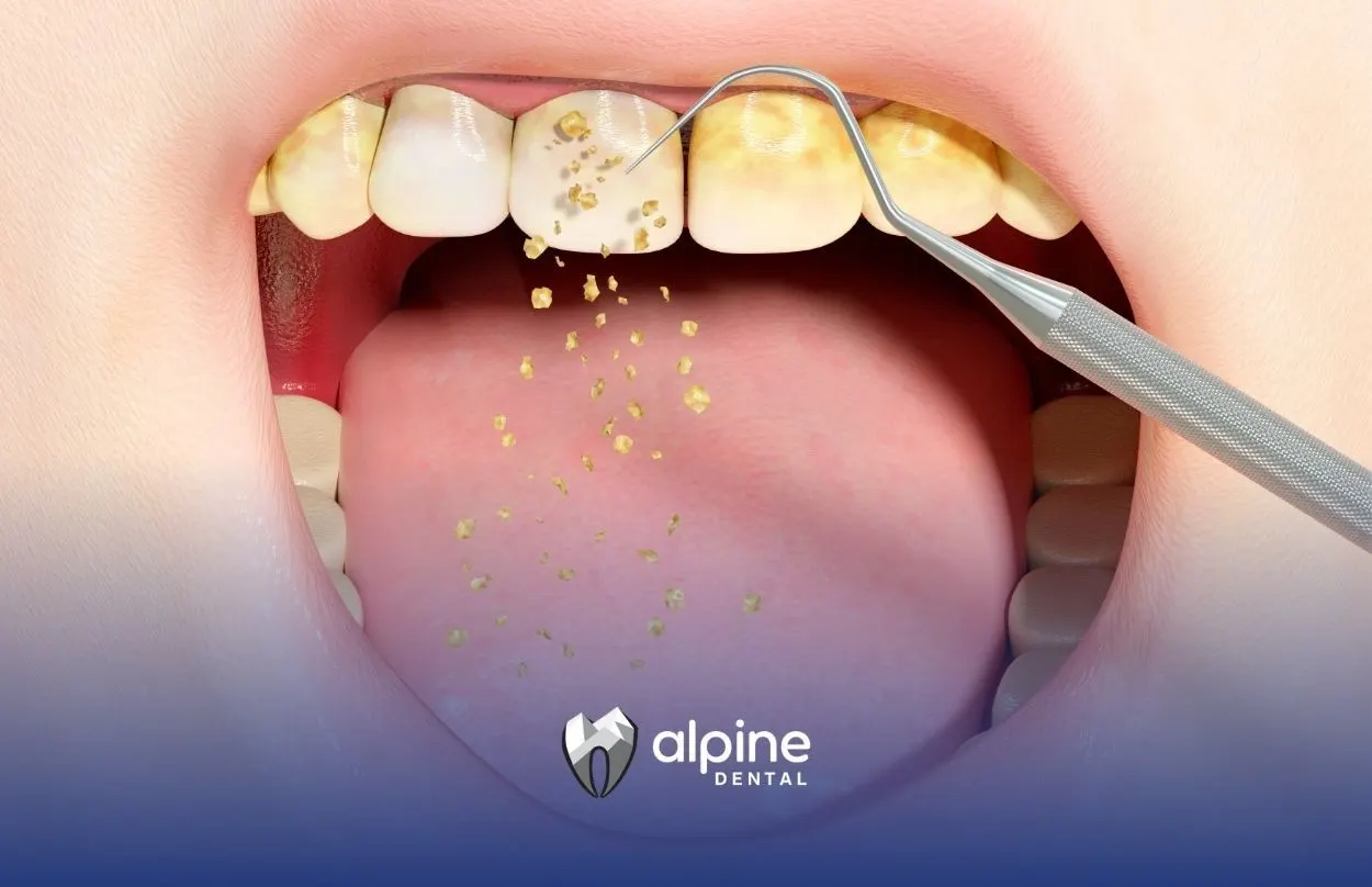 What Is Plaque? Understanding Its Causes, Effects, and Prevention