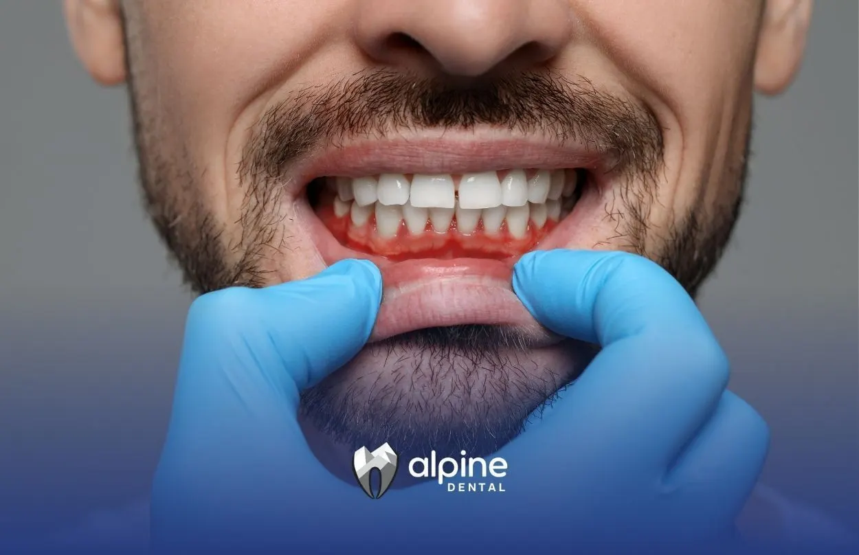 Gum Line Cavity: Everything You Need to Know