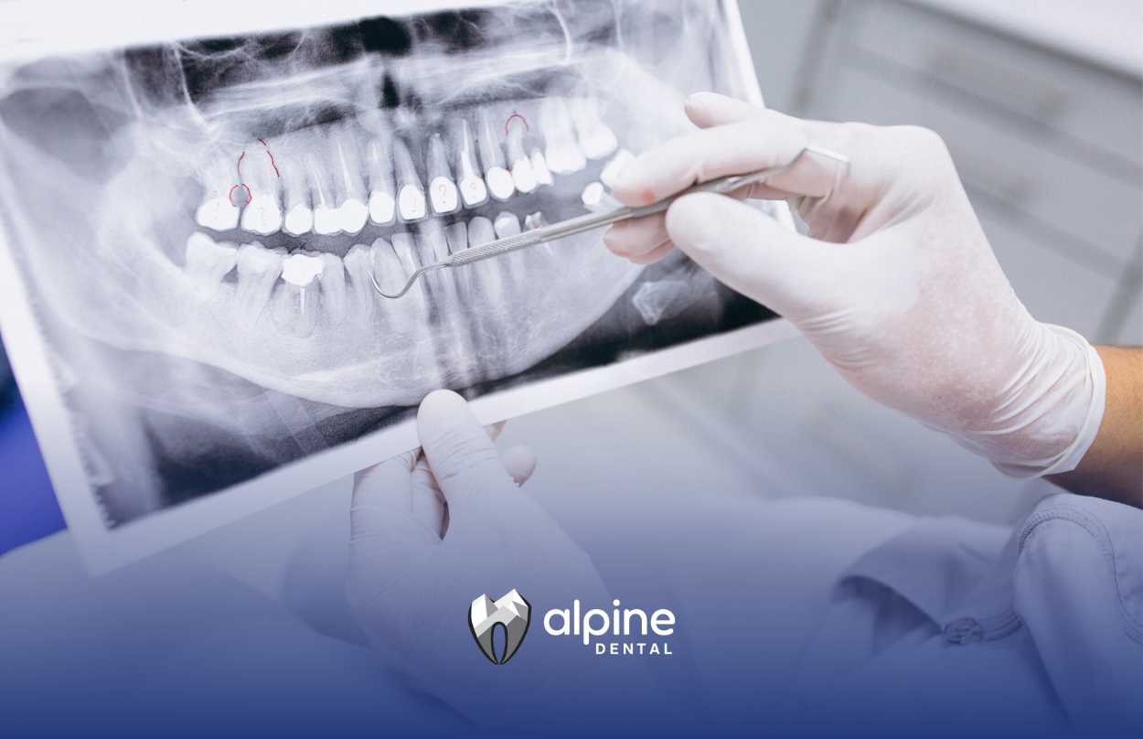 How Long Does a Root Canal Take to Heal? Recovery Timeline & Tips