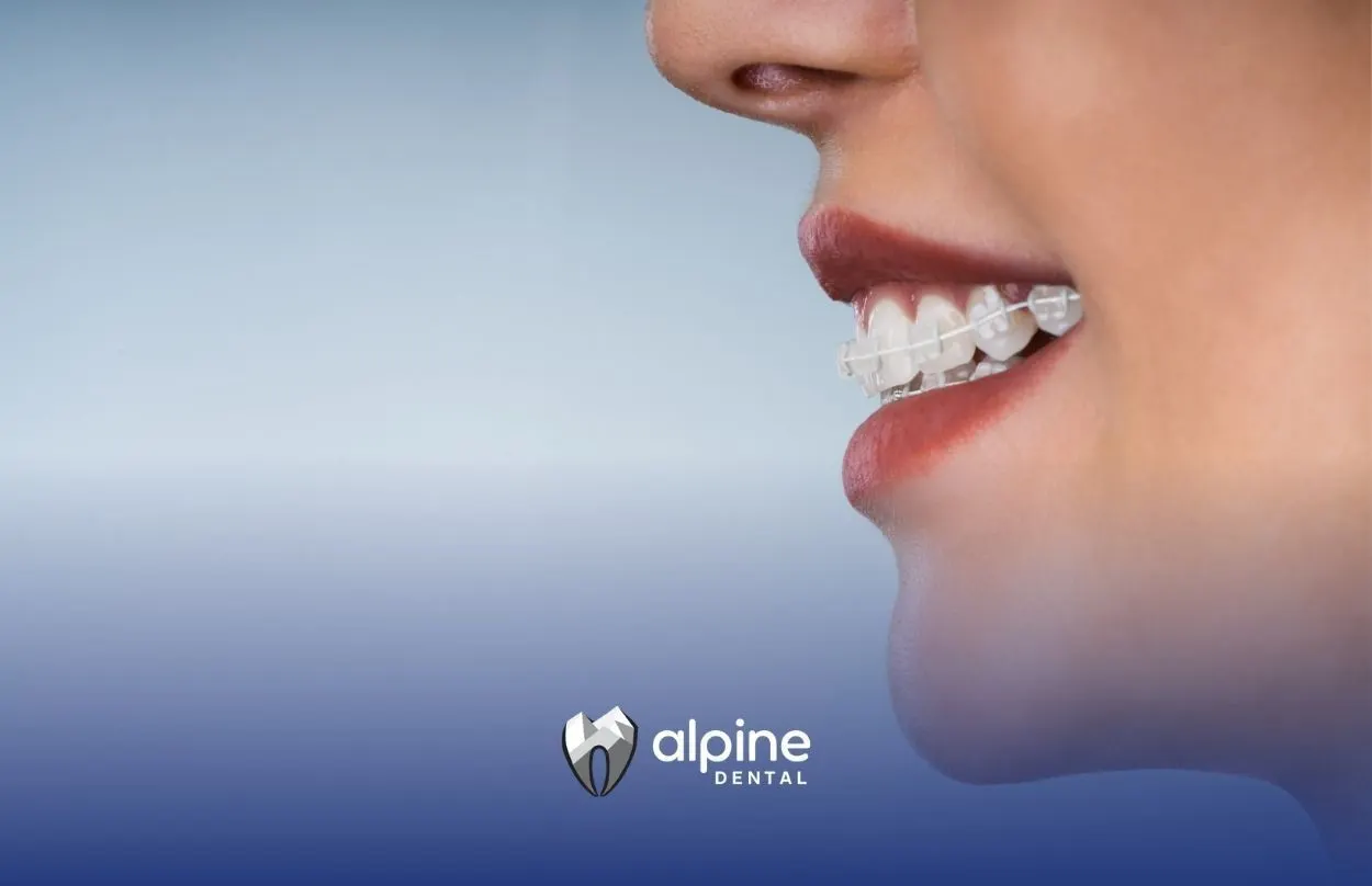 Overbite Correction: Your Comprehensive Guide from Alpine Dental
