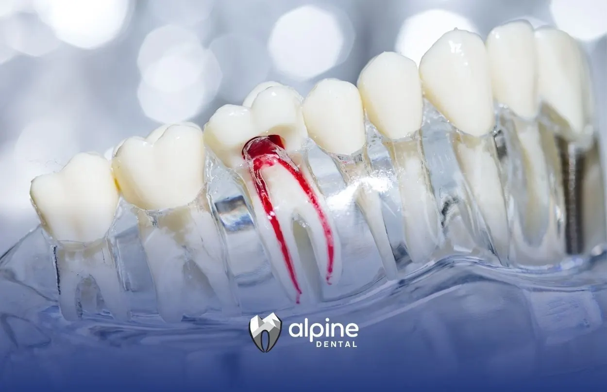 What Is a Root Canal Procedure? A Step-by-Step Guide to Saving Your Tooth
