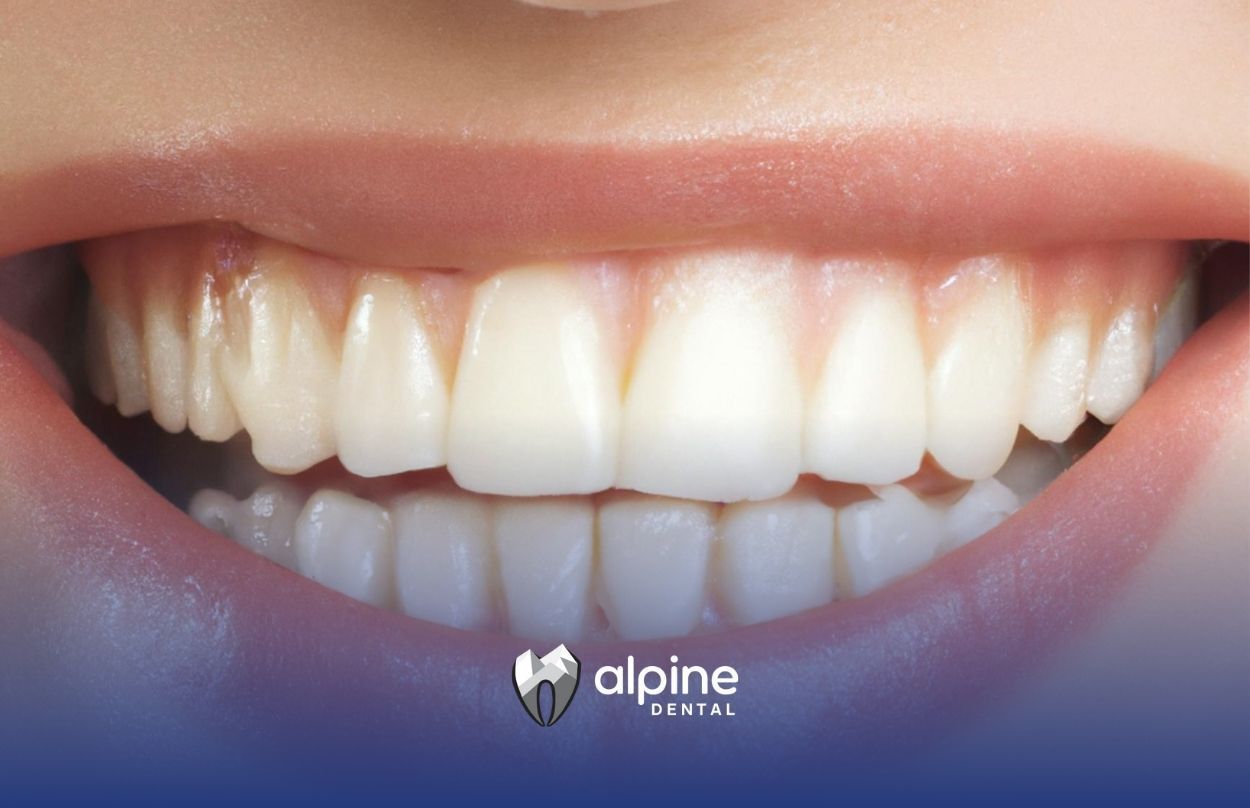 Debunking Common Teeth Whitening Misconceptions for Families