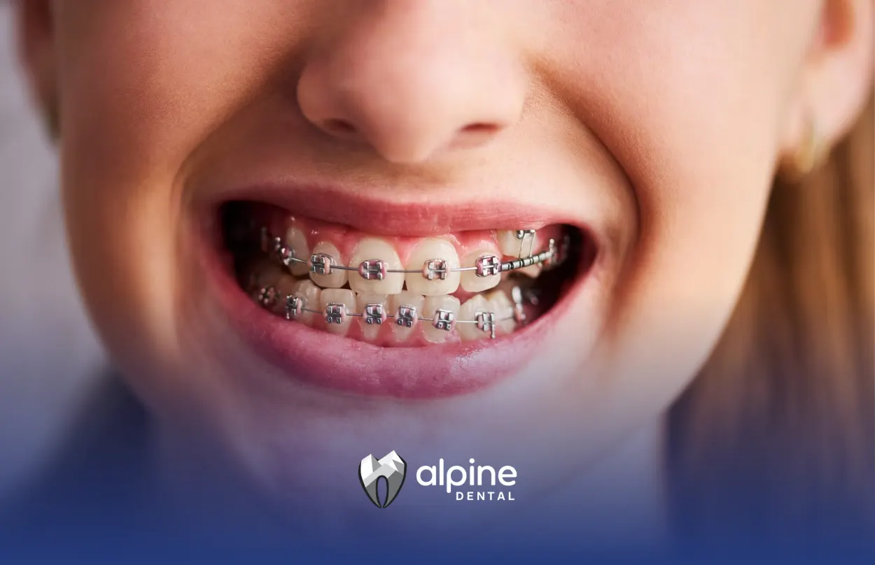 Best Toothbrush for Braces: How to Choose the Right One