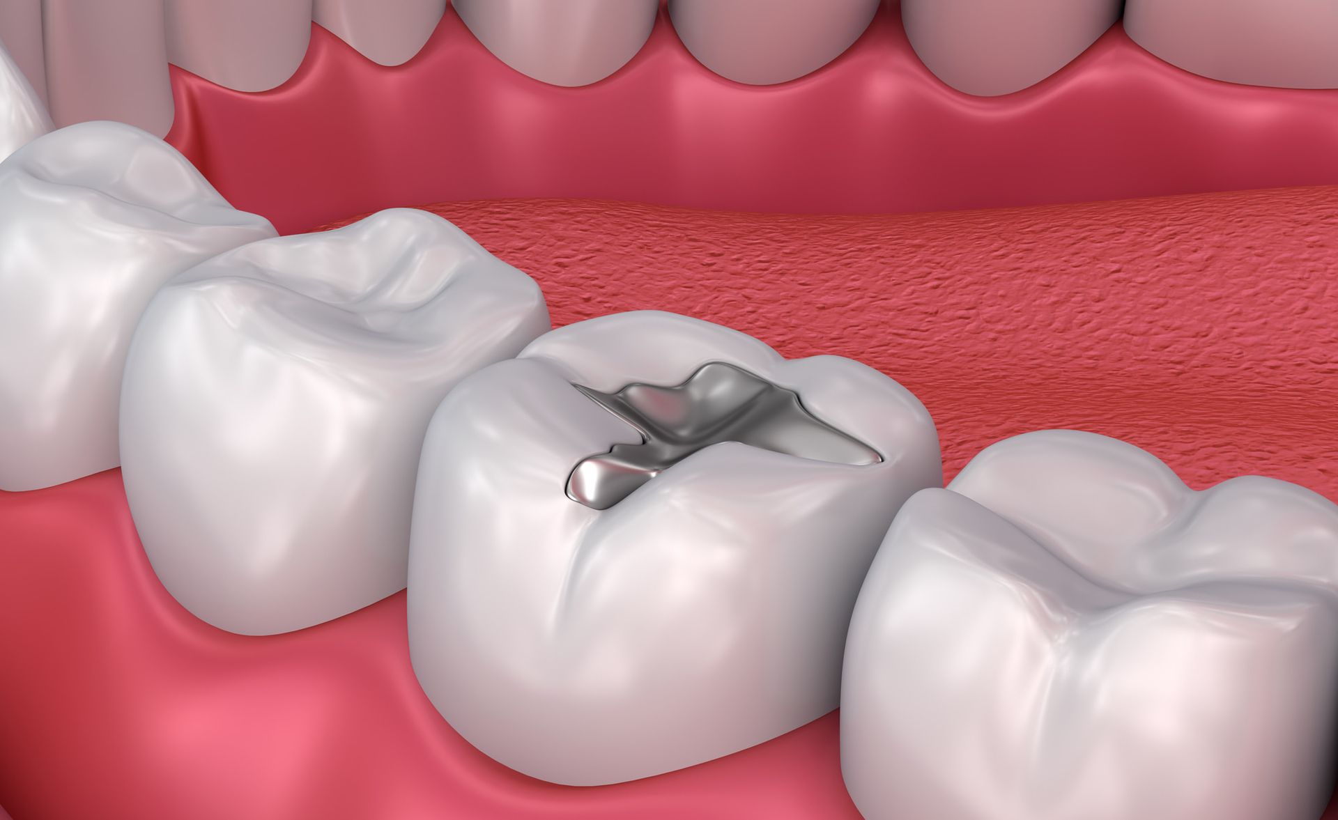 Fillings