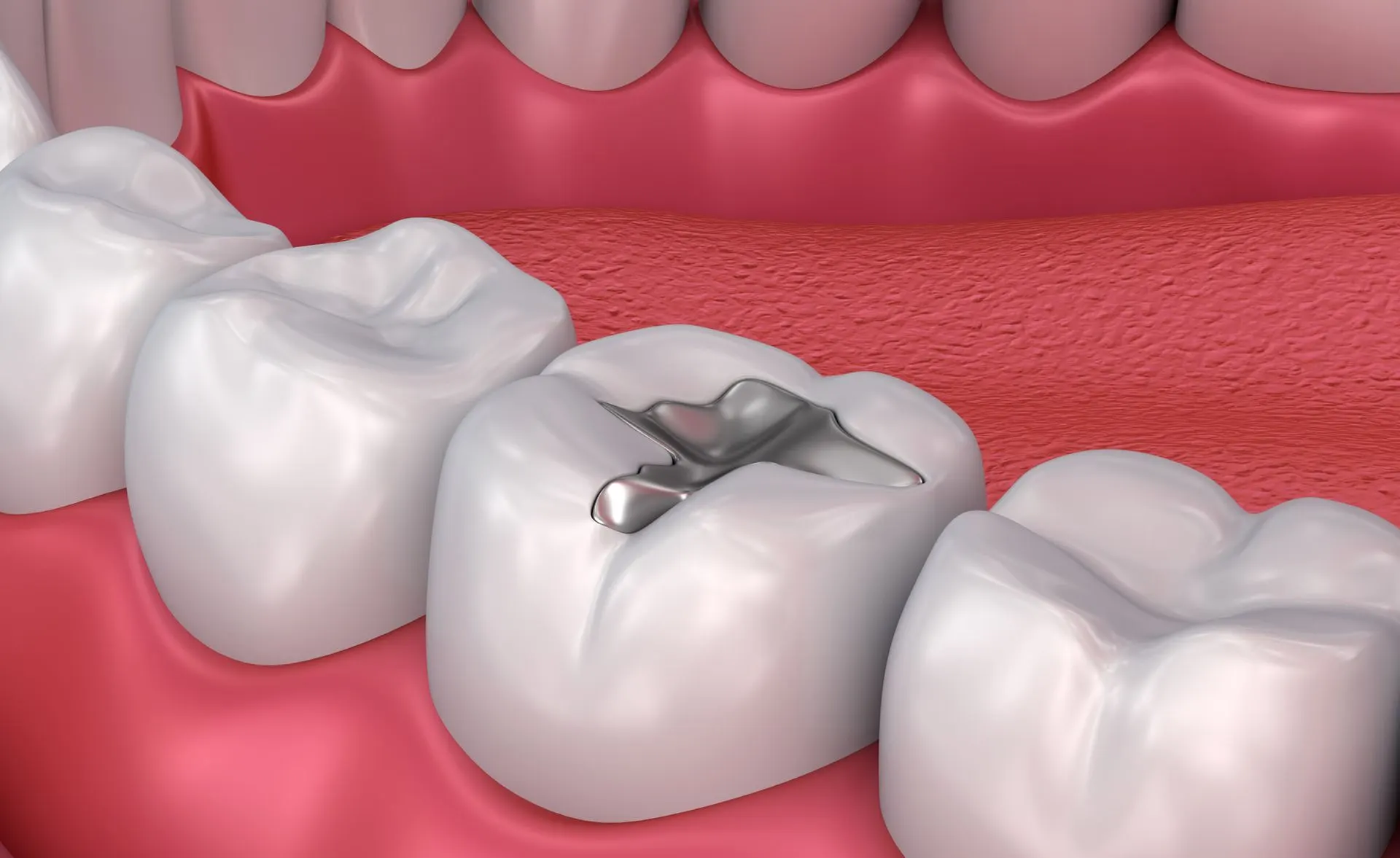Fillings